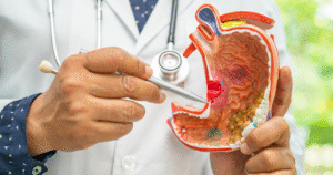 Gastric Cancer: Understanding the Silent Threat