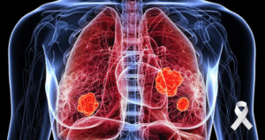 Lung Cancer: Awareness, Prevention, and Treatment